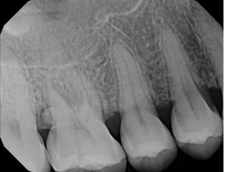<p>What dental anomaly is present in this image?</p><p> </p><p>pulpal sclerosis</p><p> </p><p>pulp stones</p><p> </p><p>hypercementosis</p><p> </p><p>enamel pearl</p>