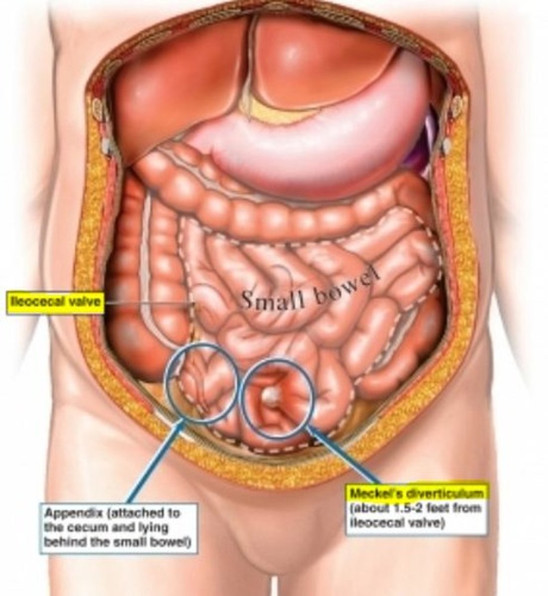 <p>outpouching of distal ileum (usually w/i 2 ft of the ileocecal valve)</p><p>- most commonly seen at 2 y/o</p><p>- male &gt; female 2:1</p>