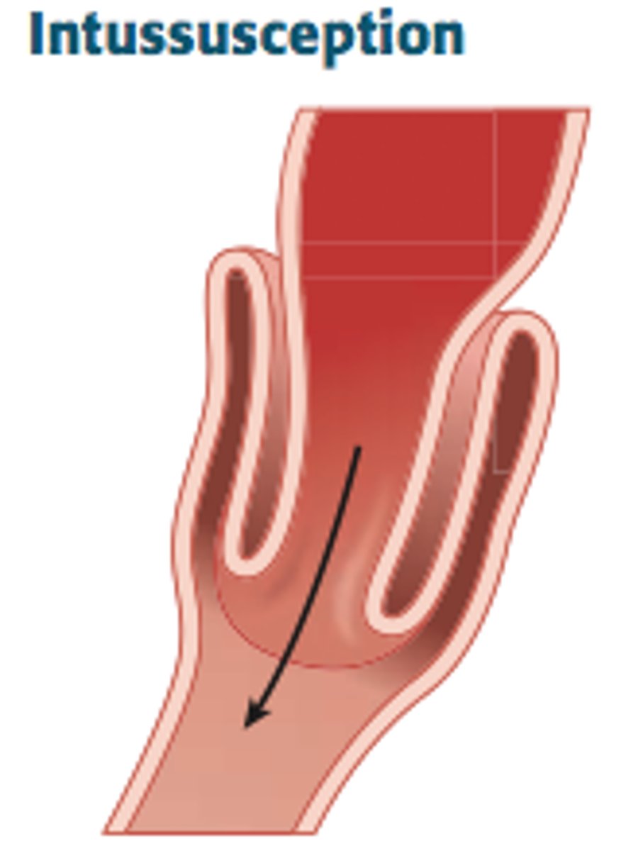 <p>The telescoping of one part of the intestinal tract into another</p>