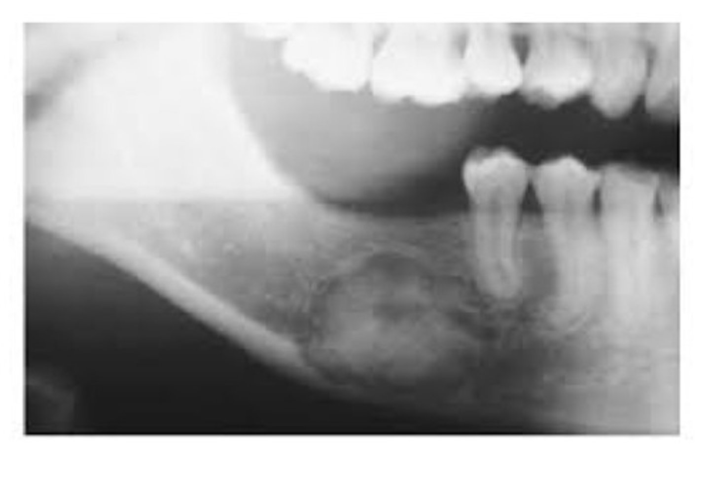 <p>A type of mesenchymal odontogenic tumour. A benign well-circumscribed tumour. Usually occurs in adults in the 3rd and 4th decades. Female sex predilection, more often in mand. Contains connective tissue and calcifications.</p>