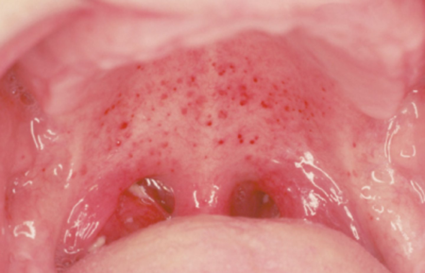 <p>small, red spots</p><p>decreased platelets</p><p>infection</p><p>trauma</p>