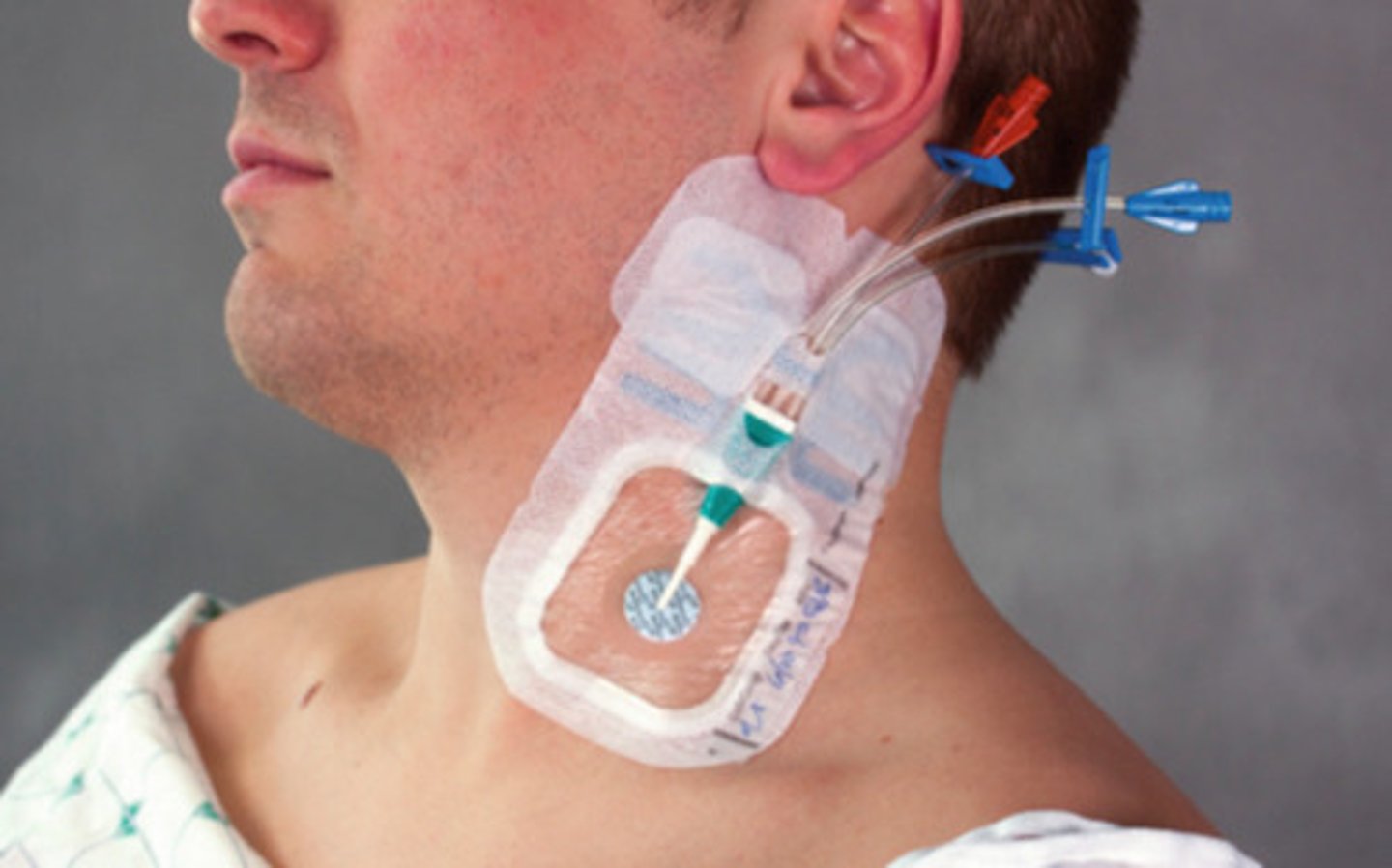 <p>-used for central venous access (jugular, subclavian, femoral)</p><p>-allows for monitoring of central venous pressure or right atrial pressure</p><p>-route for medication delivery, fluid administration, blood sampling, TPN</p><p>-peripherally inserted central catheter (PICC) line: typically placed in upper arm</p>