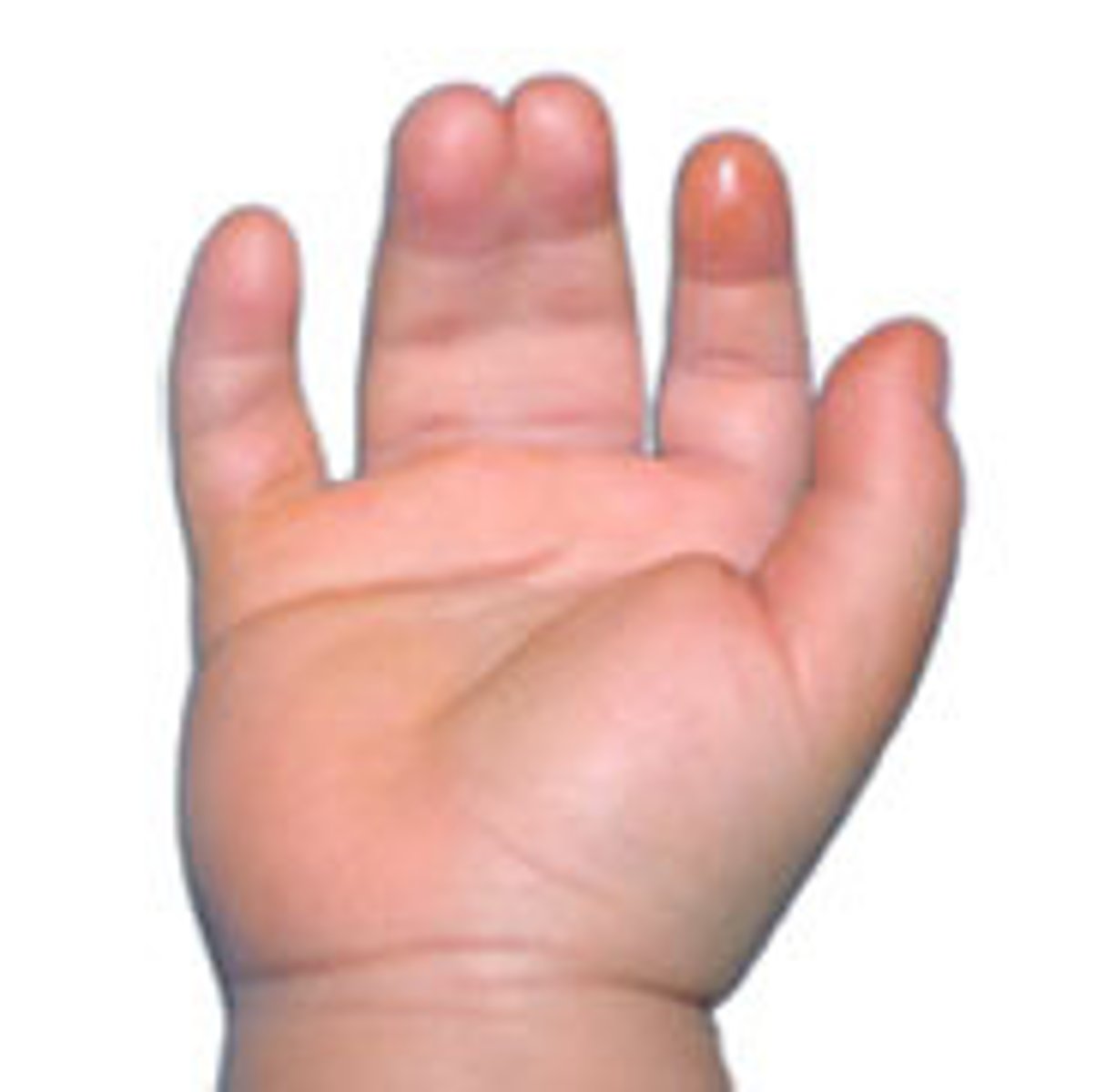 <p>FUSION of fingers or toes. This can happen incidentally in healthy infants or be associated with genetic syndromes.</p>