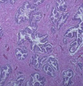 ### Hyperplasia - *Prostatic Gland*