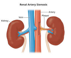 <p>Renal artery</p>