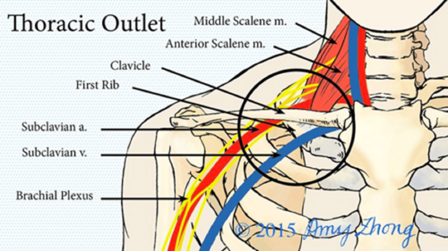 <p>•Compression of the neurovascular structures of the brachial plexus and/or subclavian vessels between the neck and axilla</p><p>•Neurogenic&nbsp;is most common (95%)</p>