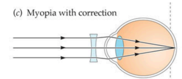 <p>fixes vision so light focuses on retina</p>