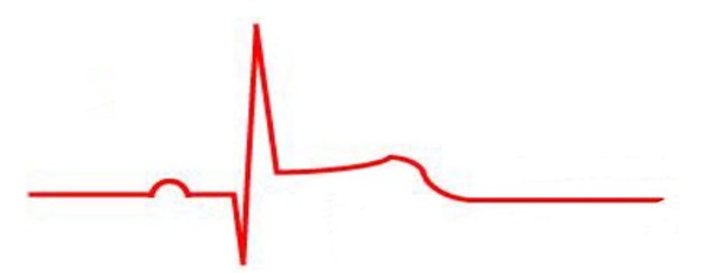 <p>Based on the ST segment, is this showing normal, ST elevation, or ST depression?</p>