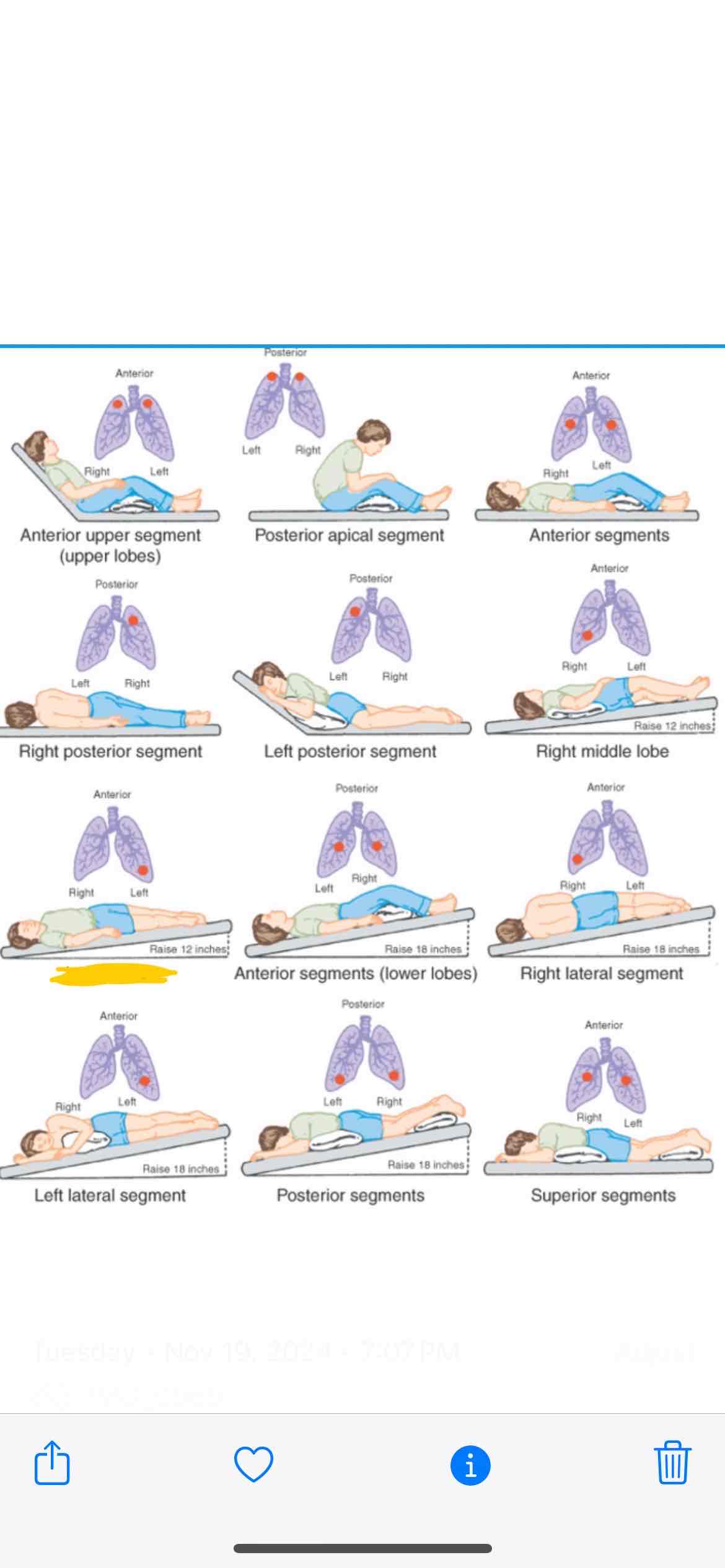 <p>Which lung segment does this position effect</p>