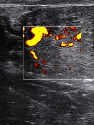 <p>granulosa cell tumour</p>