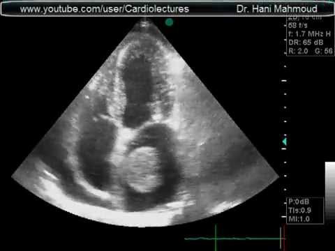 <p><span><span>What cardiac condition is demonstrated in this image?</span></span></p><p>LA myxoma</p><p>Lipoma</p><p>LA thrombus</p><p>Angiosarcoma</p><p>Rhabdomyosarcoma</p>