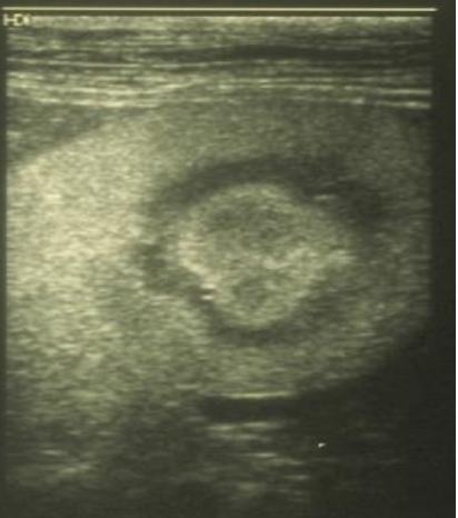 <p>seen in stage 3, increase renal cortical and medullary echogenicity </p>