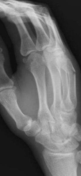 <p>What is the name of this fracture?</p>