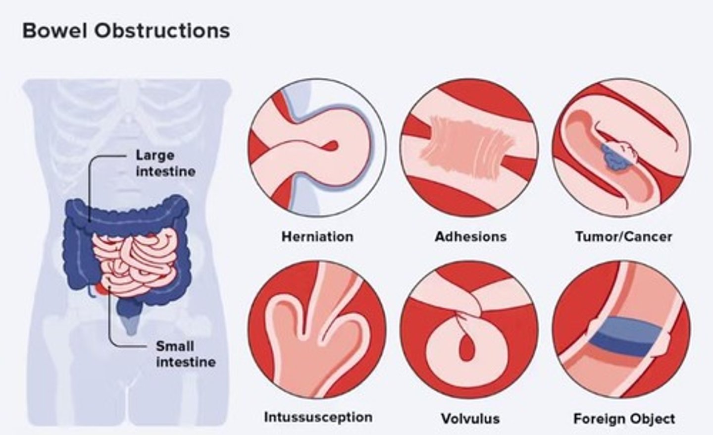 <p>A blockage that prevents the normal flow of intestinal contents through the intestinal tract.</p>