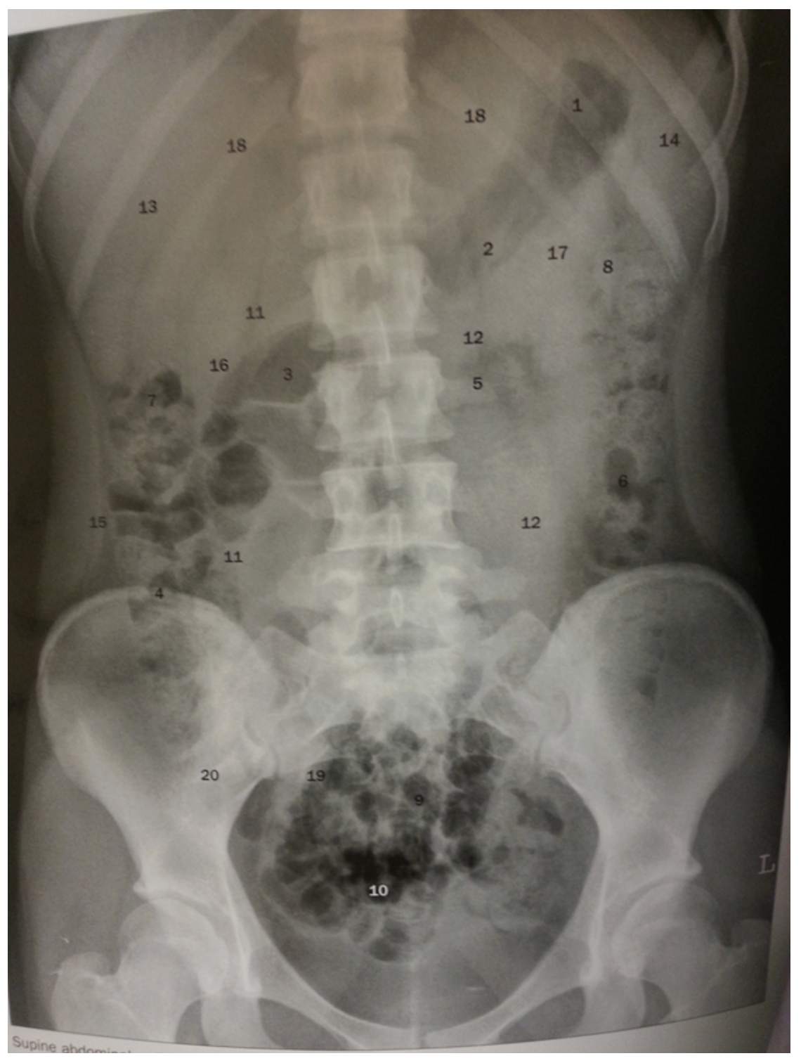 <p>In the interpretation of an abdomen image (attached), in which of the following categories would the liver (13) be included?</p>