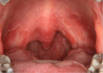 <p>erythematous patches on surfaces other than the tongue</p>
