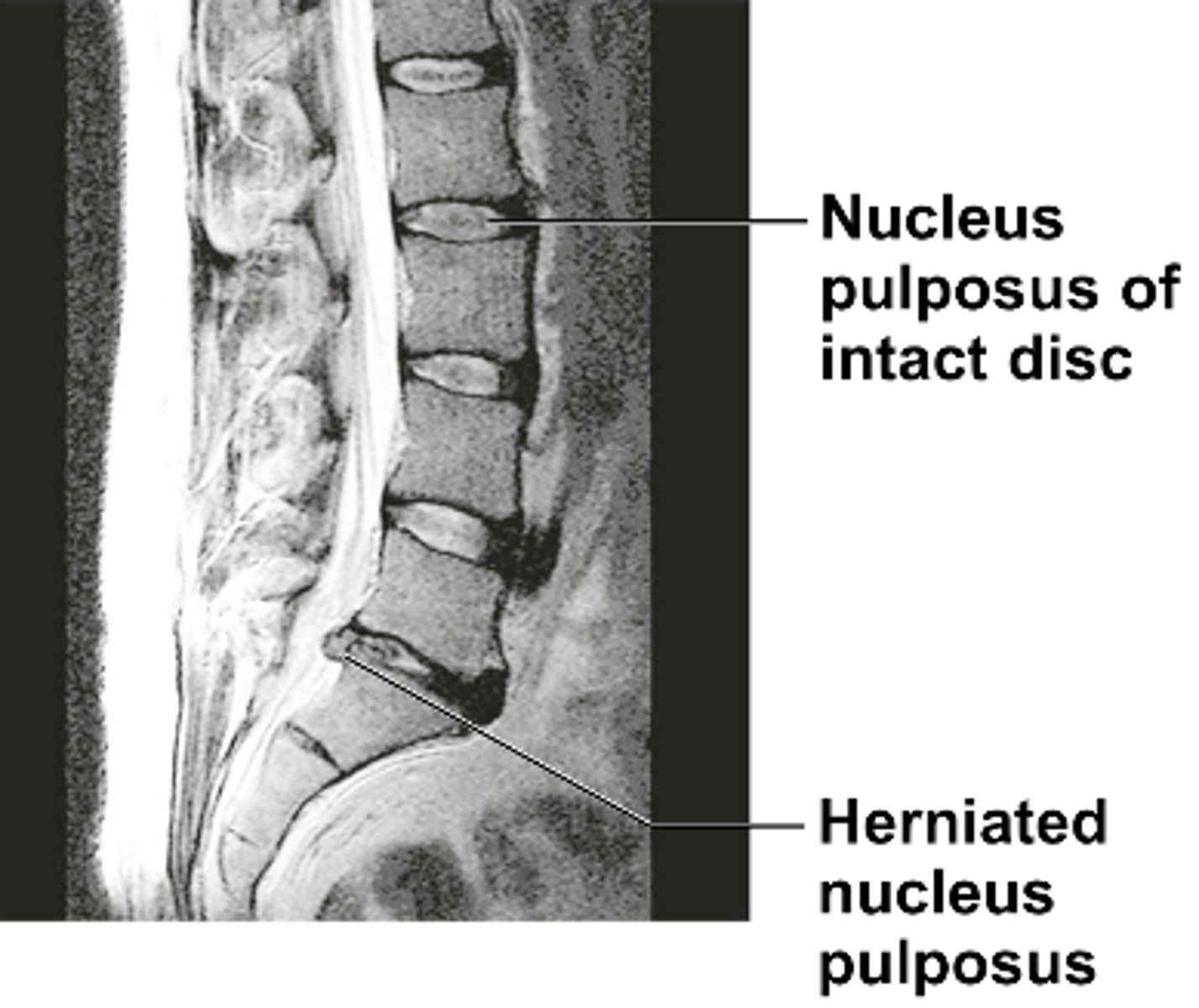 <p>Common in lumbar spine; outward bulging causes pressure on spinal cord</p>