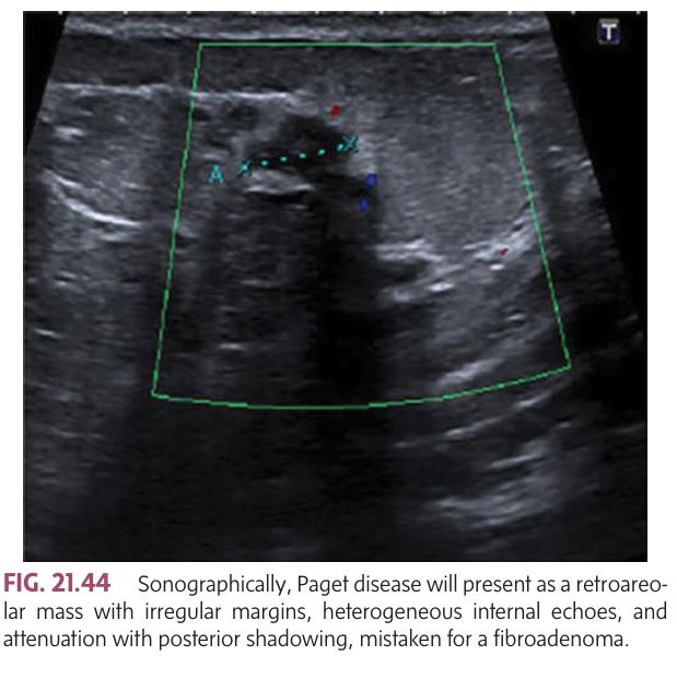 <ul><li><p class=""><mark data-color="yellow" style="background-color: yellow; color: inherit">This is a relatively rare tumor and it typically occurs in women over 50 years of age.</mark><br><strong>Description</strong>:</p><ul><li><p class="">A rare tumor that arises in the retroareolar ducts and grows towards the nipple, spreading into the intraepidermal region of the nipple and areola.</p></li><li><p class="">Characterized by a<strong> rash-like appearance, </strong>which may be confused with melanoma.</p></li></ul><p class=""><strong>Signs &amp; Symptoms</strong>:</p><ul><li><p class="">Ulceration, enlargement, or deformity of the nipple and areola.</p></li><li><p class=""><strong>Rash-like appearance</strong>, often mistaken for a benign inflammatory eczematous condition.</p></li><li><p class="">Palpatory findings may not always be present.</p></li></ul><p class=""><strong>Sonographic Features</strong>:</p><ul><li><p class="">Retroareolar mass with irregular margins.</p></li><li><p class="">Heterogeneous internal echoes.</p></li><li><p class="">Attenuation with posterior shadowing.</p></li></ul></li></ul><p></p>
