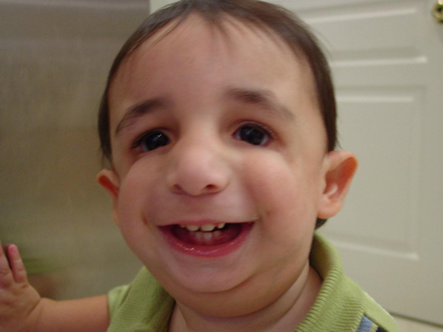 <p>Autosomal dominant, sometimes spontaneous mutation</p><p>underdeveloped facial bones, mandibular hypoplasia, cheek hypoplasia, dental malocclusion, hypoplasia, high hard palate, cleft palate in about 30% of cases</p><p>congenital, bilateral, conductive HL, sometimes sensorineural loss, hypernasality and nasal emission, artic disorders</p>