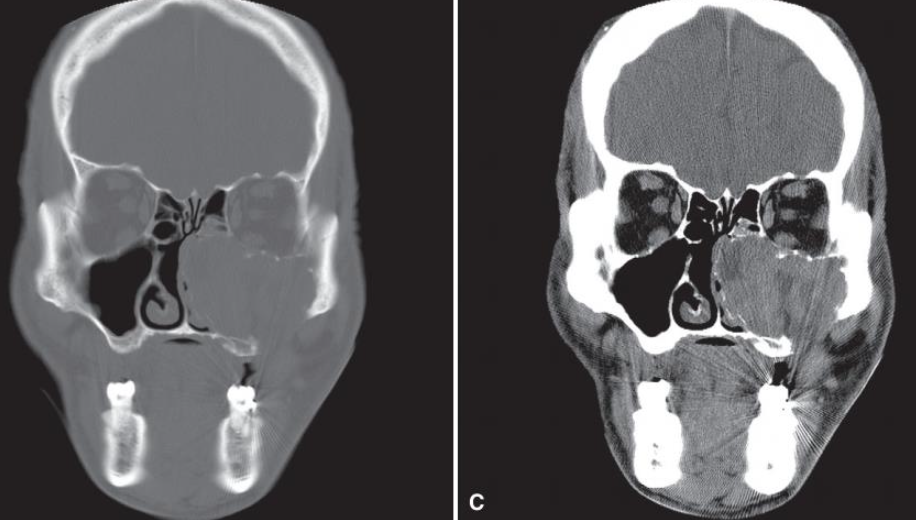 <p>Ameloblastoma</p>