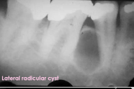 <p>Lateral radicular cyst</p>