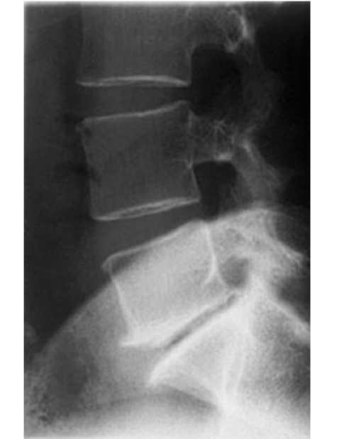 <ul><li><p>pincement discal</p></li><li><p>Ostéophytes antérieurs</p></li></ul><p></p>