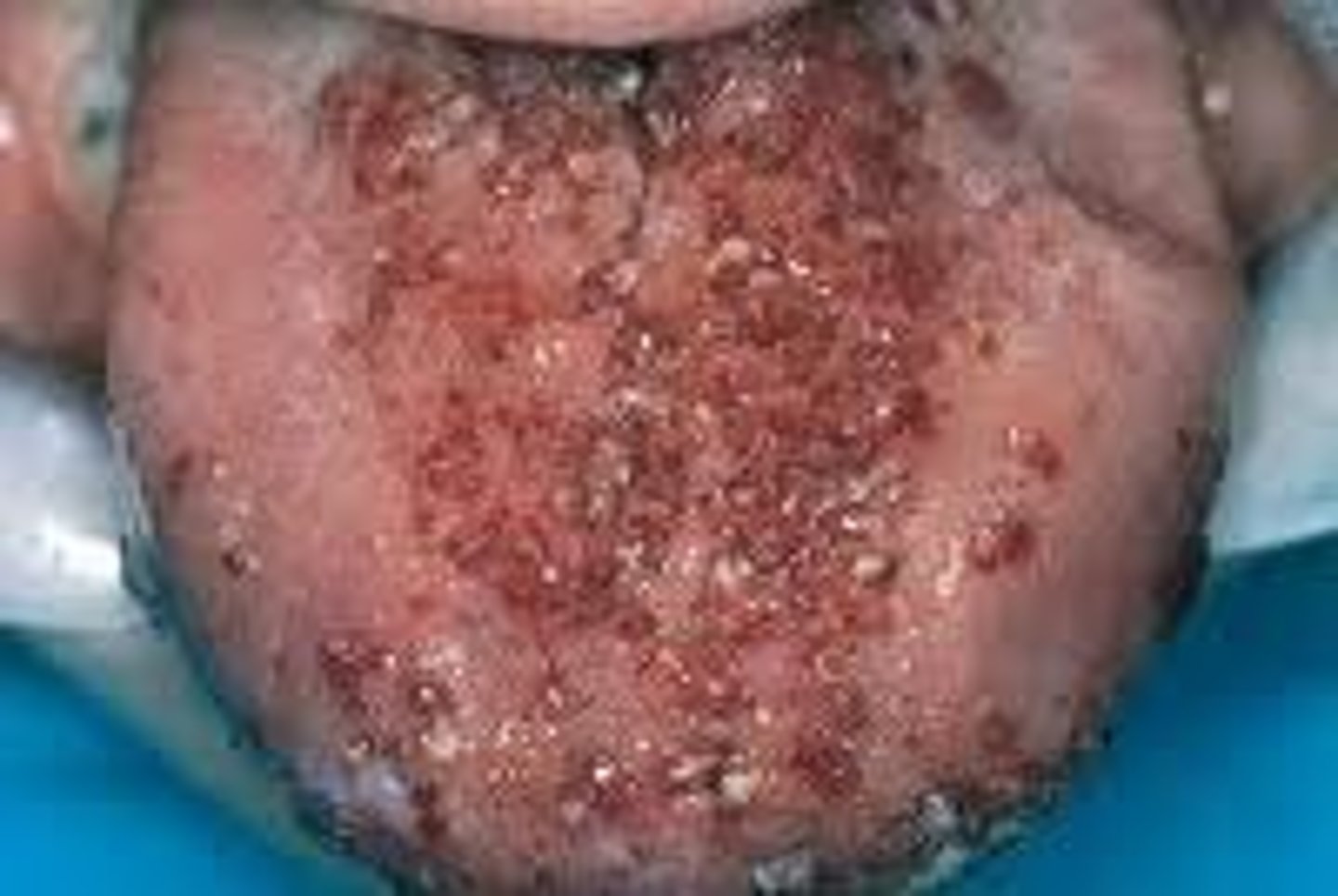 <p>Lymphangioma - treatment</p>