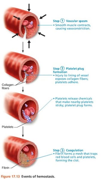<p>1. Break in the vessel wall<br>2. As blood escapes, platelets contact collagen fibers<br>3. Platelets stick to collagen and each other, forming a platelet plug<br>-platelet releases serotonin(vasoconstrictor) and prothrombin activator<br>-the prothrombin activator with calcium turns prothrombin(inactive) into thrombin(active)<br>-Thrombin(active) turns fibrinogen(soluble) into fibrin(insoluble)<br>4. This creates a blood clot</p>