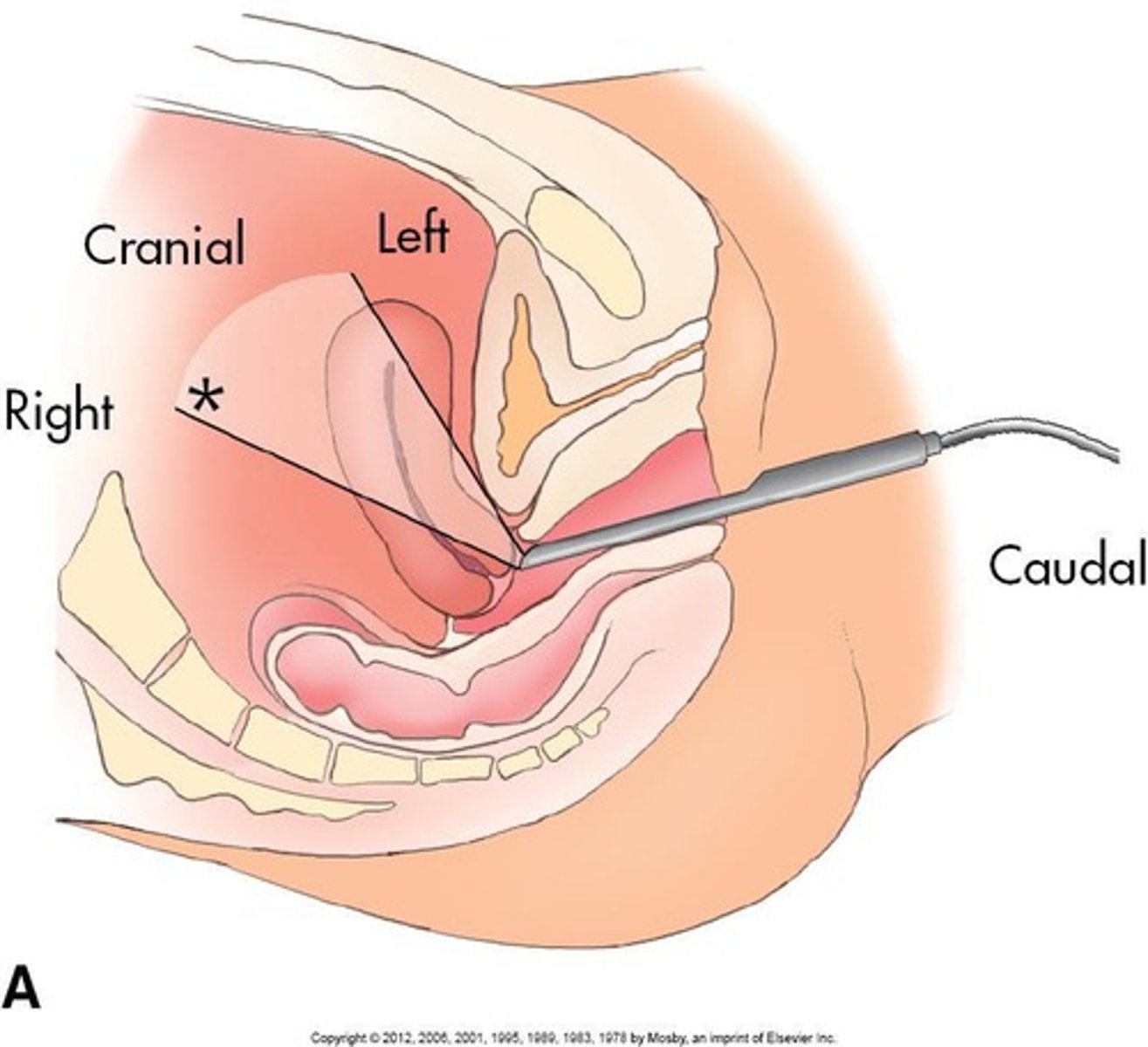 <p>Ultrasound technique using vaginal probe.</p>
