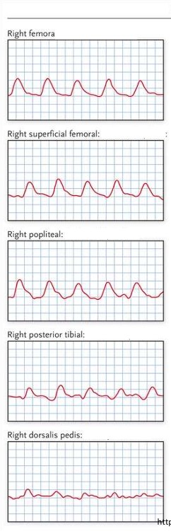 <ol><li><p>What kind of waveforms are seen here?</p></li><li><p>If this was taken on a CW doppler exam, is the waveform normal or abnormal? </p></li></ol><p></p>