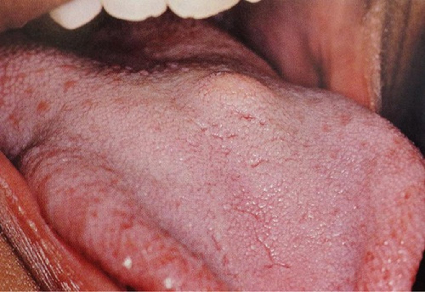 <p>soft, yellowish-pink, painless nodule</p><p>• less than 2cm</p><p>• common location: dorsal tongue</p><p>• population: females 30-50</p>