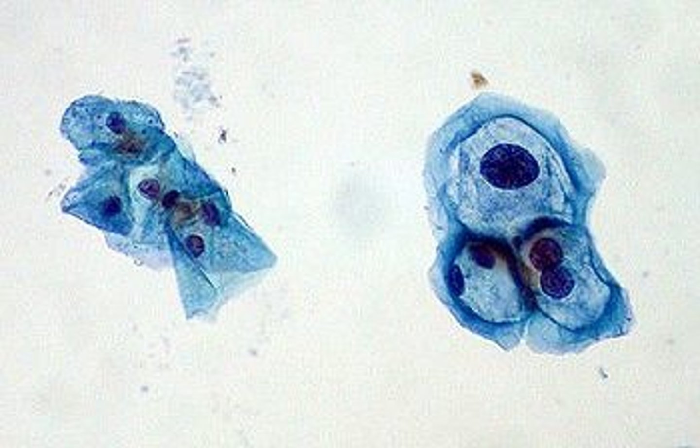<p>cells with empty open-looking cytoplasm seen on a Pap smear, always precede cancer</p>