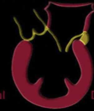 <p>Which cardiomyopathy is most common and characterized by the dilation and impaired contraction of one/both of the ventricles NOT caused by HTN, coronary atherosclerosis, valvular dysfunction, or structural heart disease?</p>