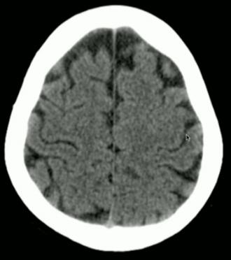 <p>What Meningeal Layers are visible?</p>