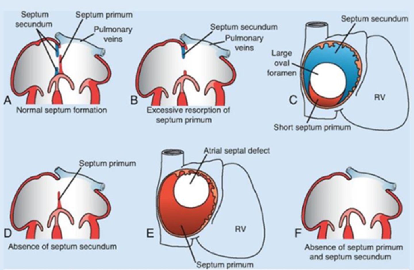 <p>• First wall: septum primum grows down → leaves a hole (ostium primum).</p><p>• That hole closes, but new hole (ostium secundum) opens higher.</p><p>• Second wall: septum secundum grows, leaves an opening called foramen ovale</p>