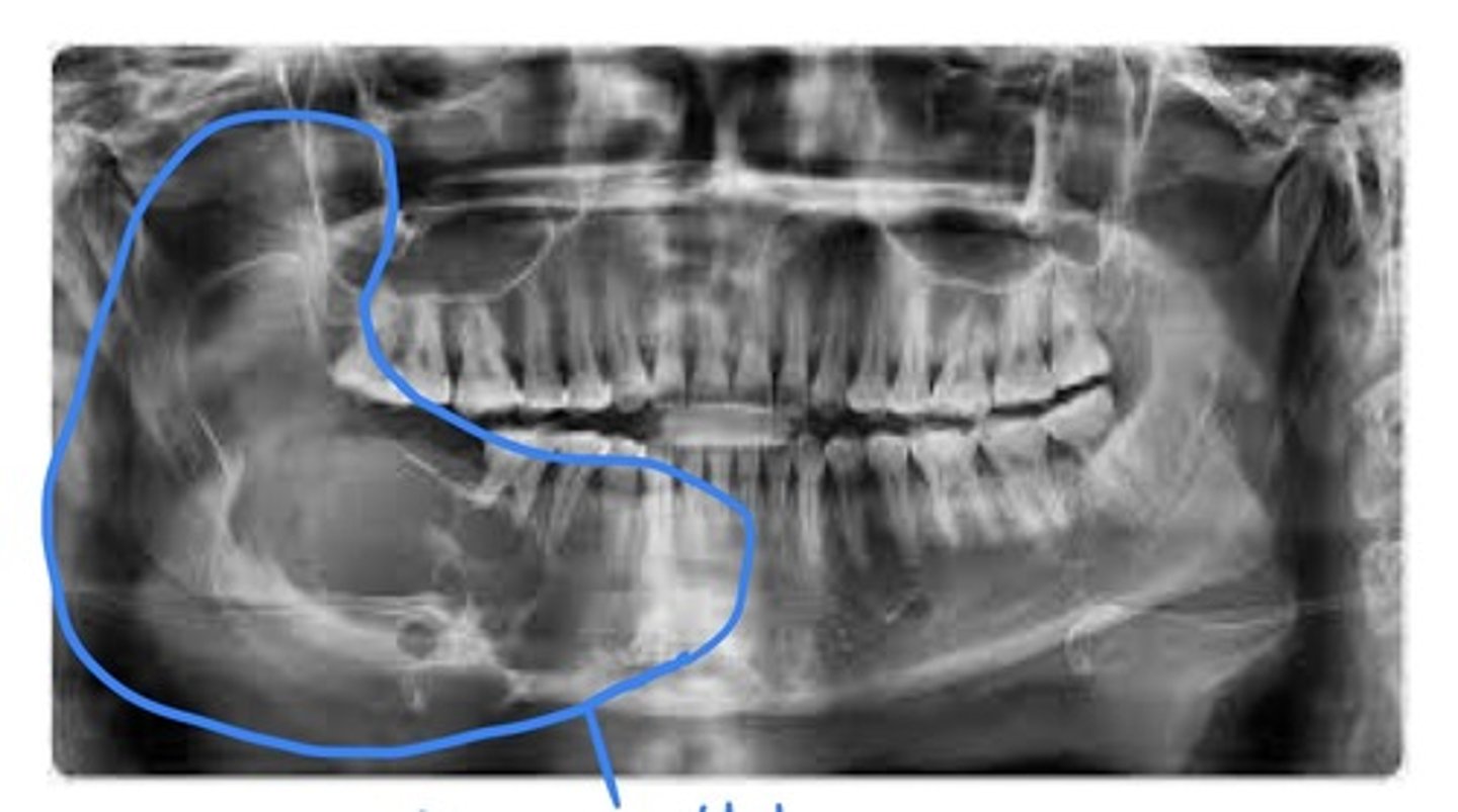 <p>A benign, slow-growing but locally aggressive epithelial odontogenic tumour. May occur in either mandible or maxilla, most often in the mandible in the molar or ramus area. Unencapsulated, infiltrates into surrounding tissue. Radiographic: a multilocular soap bubble-like or honeycombed radiolucency. May occur anywhere in jaws; can occur in association with a dentigerous cyst, may cause bone expansion. Recurrence is common.</p>