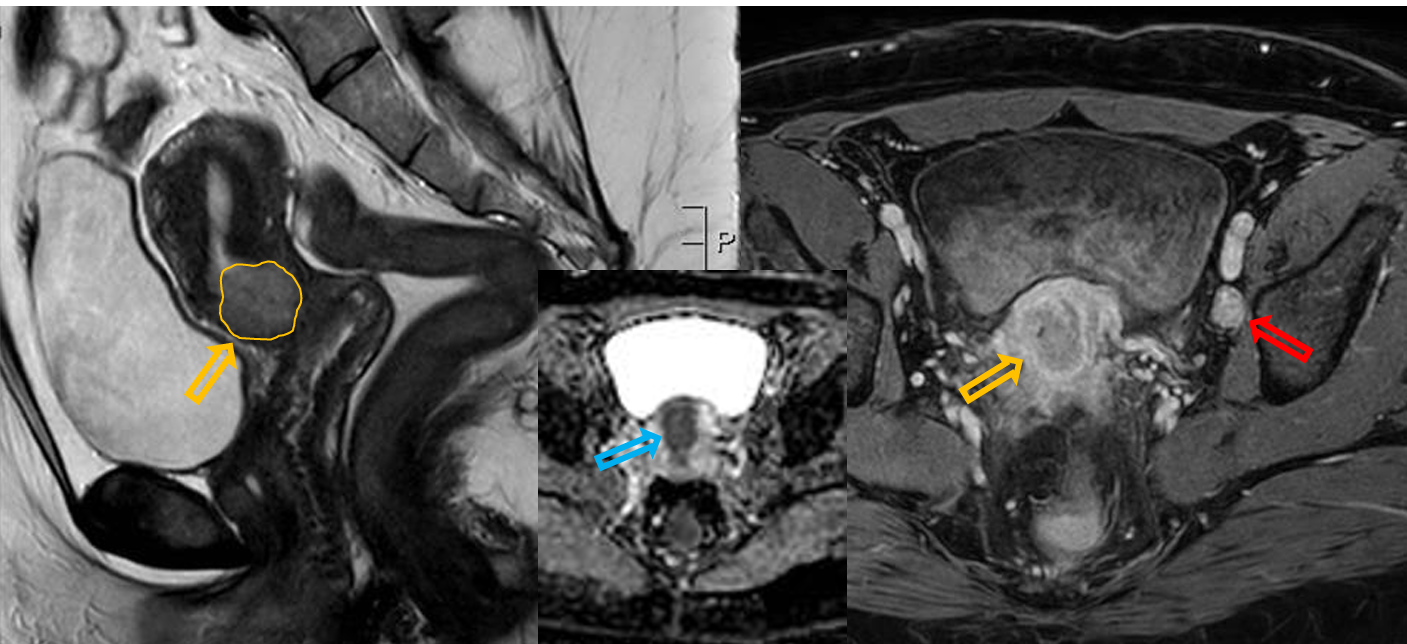 <p>Patient history: vaginal bleeding, pelvic pain, colposcopy-guided cervical biopsy identified cervical cancer </p><p>Modality: left image – T2W sagittal MRI; middle image – ADC map axial MRI; right image – postcontrast T1W fatsat, axial MRI (iv. gadolinium) </p><p>Region: pelvis </p><p>Radiologic sign: Contrast-enhancing, cervical mass infiltrating the myometrium (yellow arrow), showing diffusion restriction (blue arrow) and T2-hyperintensity. A pathologically enlarged right iliac lymph node is visible (red arrow). </p><p>Diagnosis: cervical carcinoma with locoregional lymphadenopathy</p>