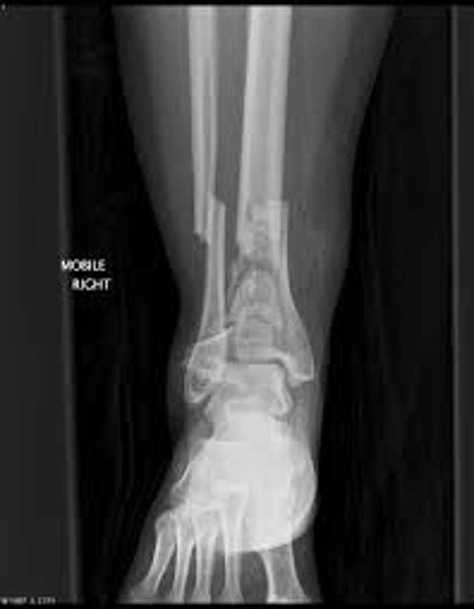 <p>pilon fracture → s/p trauma → 75% also have fibula fx</p><p>ortho referral!!!</p>