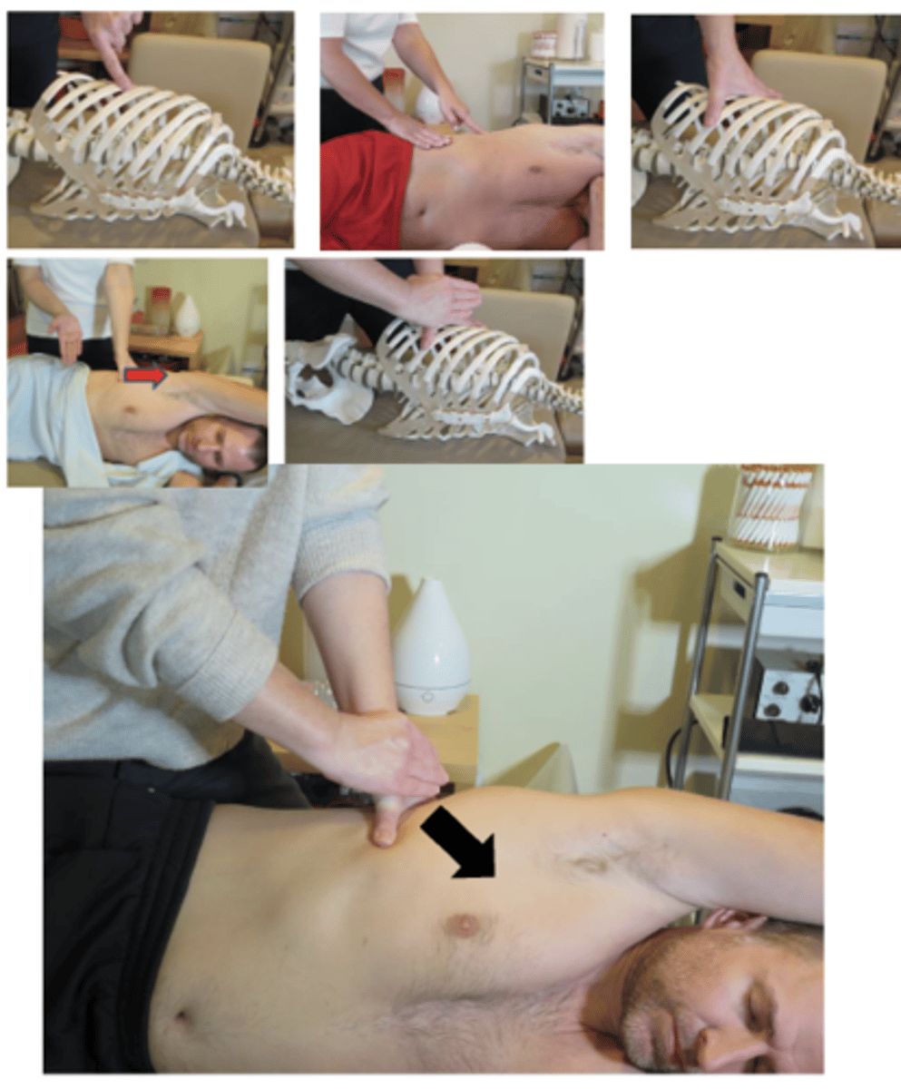 <p>• PP: Side lying, dysfunctional side up , arm abducted overhead, permission to open gown/contact, identify finding segment, roll may be used under thorax to induce lateral flexion</p><p>• DP: Stand behind patient in a fencer stance, inferior to contact, preparing to develop pre-adjustive tension by leaning headword, tissue drawn from below contact up to rib (I-S)</p><p>• CH: Web contact of cephalad (outside) hand slides onto inferior margin of superior rib of dysfunction</p><p>• IH: Supports the contact hand, on dorsal surface, with fingers wrapped around the wrist</p><p>• LOD: I-S and L-M (Taking care to avoid excessive medial pressure to the rib cage)</p><p>* R3-R12</p>