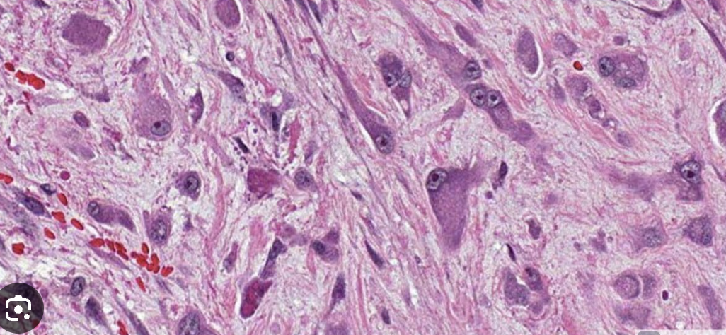 <p>1)Fascéite nodulaire</p><p>2)</p><ul><li><p>Moins de 3cm</p></li></ul><p>3)</p><ul><li><p>Accolé à un fascia (bande éosinophile) mais parfois dans le derme</p></li><li><p>Espaces myxoïdes et kystiques, parfois collagénique</p></li><li><p>Prolifération myofibroblastique : tissue culture avec aspect de tissu de granulation</p></li><li><p>Pas de pléomorphisme (parfois on retrouve des cellules ganglionaire like (photo)</p></li><li><p>Erythrocytes extravasés </p></li><li><p>Fibres musculaires disséquées</p></li></ul><p>4) </p><ul><li><p>SMA+, DES-,Caldesmon</p></li></ul><p>5) MYH9-USP6</p><p></p>