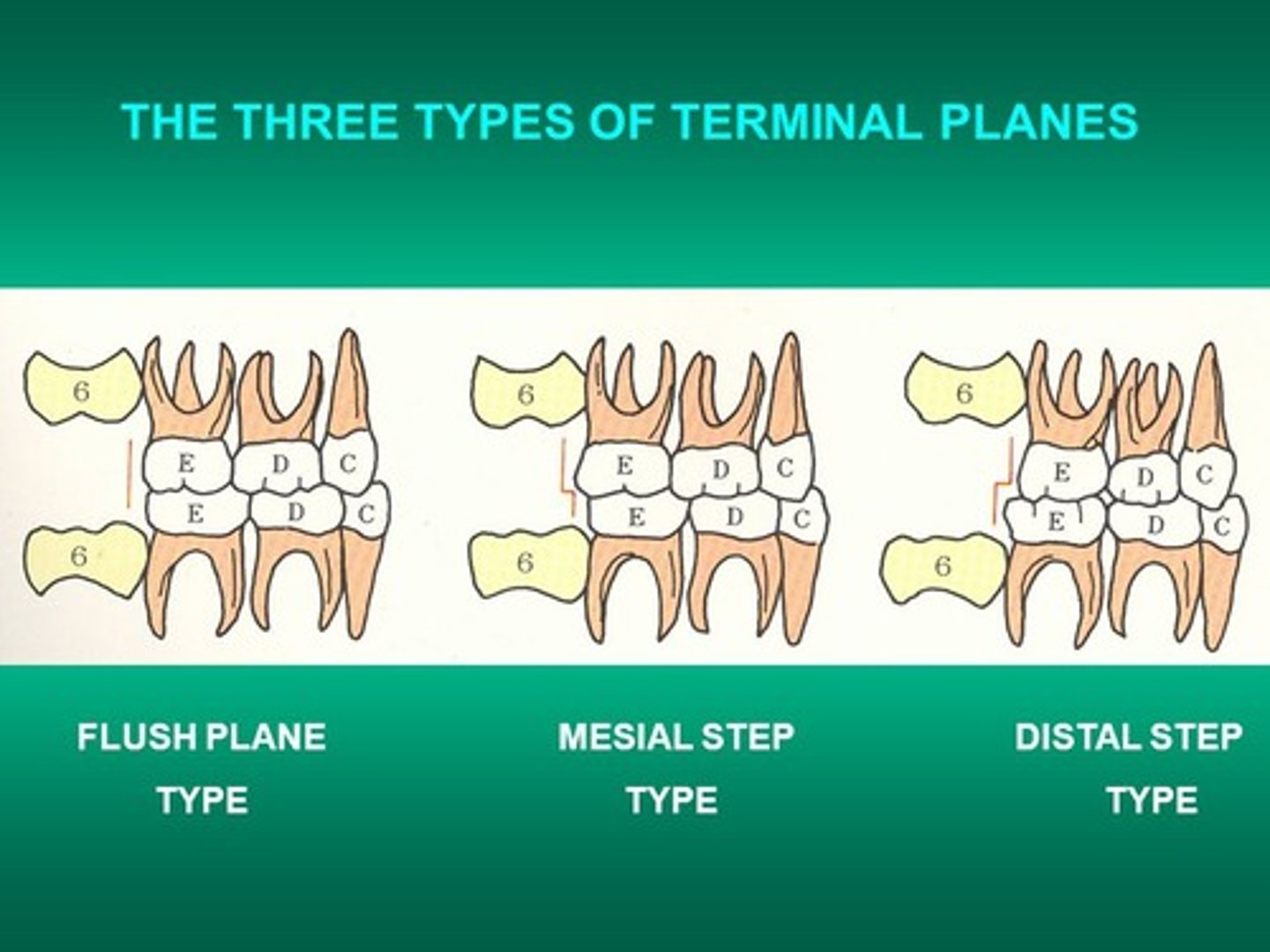 <p>primary mandibular second molar is mesial to the maxillary second molar</p>