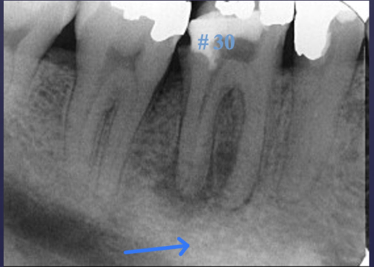 <p>Is this radiolucent inflammation classified as rarefying or sclerosing?</p>