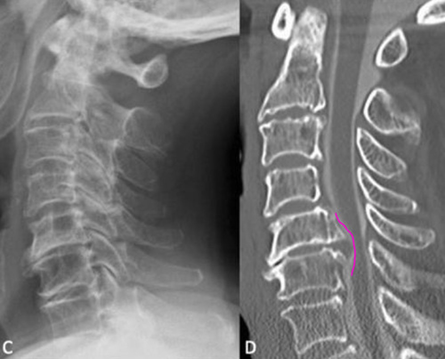 <p>What is so dangerous of OPLL (ossification of PLL)?</p>