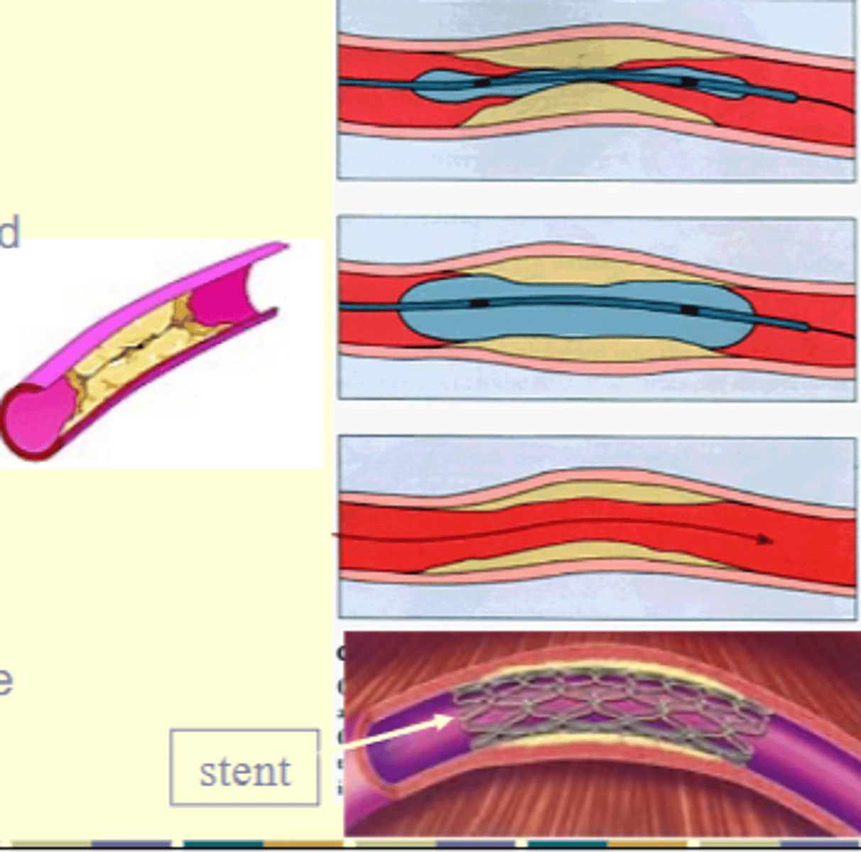 <p>Balloon Angioplasty</p>