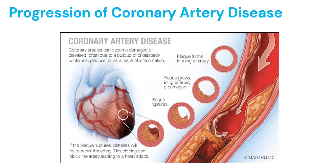 <ul><li><p>May get complete obstruction of the vessel, cutting off the oxygen supply (STEMI)</p></li><li><p>Troponin being released in bloodstream is key in diagnosing MI</p></li></ul><div data-type="horizontalRule"><hr></div><ul><li><p>Asymptomatic CAD = no symptoms, but have disease = coronary calcium score = tells us of the plaque in arteries since calcium stabilizes clots&nbsp;</p></li></ul><ul><li><p>Stable angina = chest pain with activity, goes away with rest = oxygen demand high, but supply low&nbsp;</p></li><li><p>With unstable angina, symptoms may occur at rest; become more frequent, severe, or prolonged than the usual pattern of angina; change from the usual pattern of angina; or not respond to rest or nitroglycerin (<strong>chest pain at rest shows myocardial ischemia</strong>) = no calcium</p></li></ul><ul><li><p>NSTEMI - partial blockage = troponins present</p></li><li><p>STEMi - complete blockage = ST elevation on EKG troponins present = worse</p></li></ul><p></p><p></p>