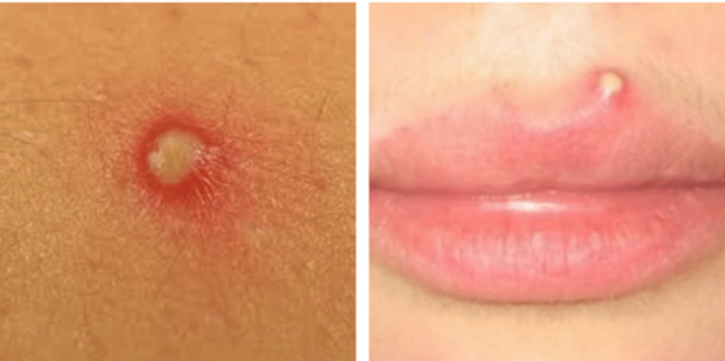 <p>Pustules</p>
