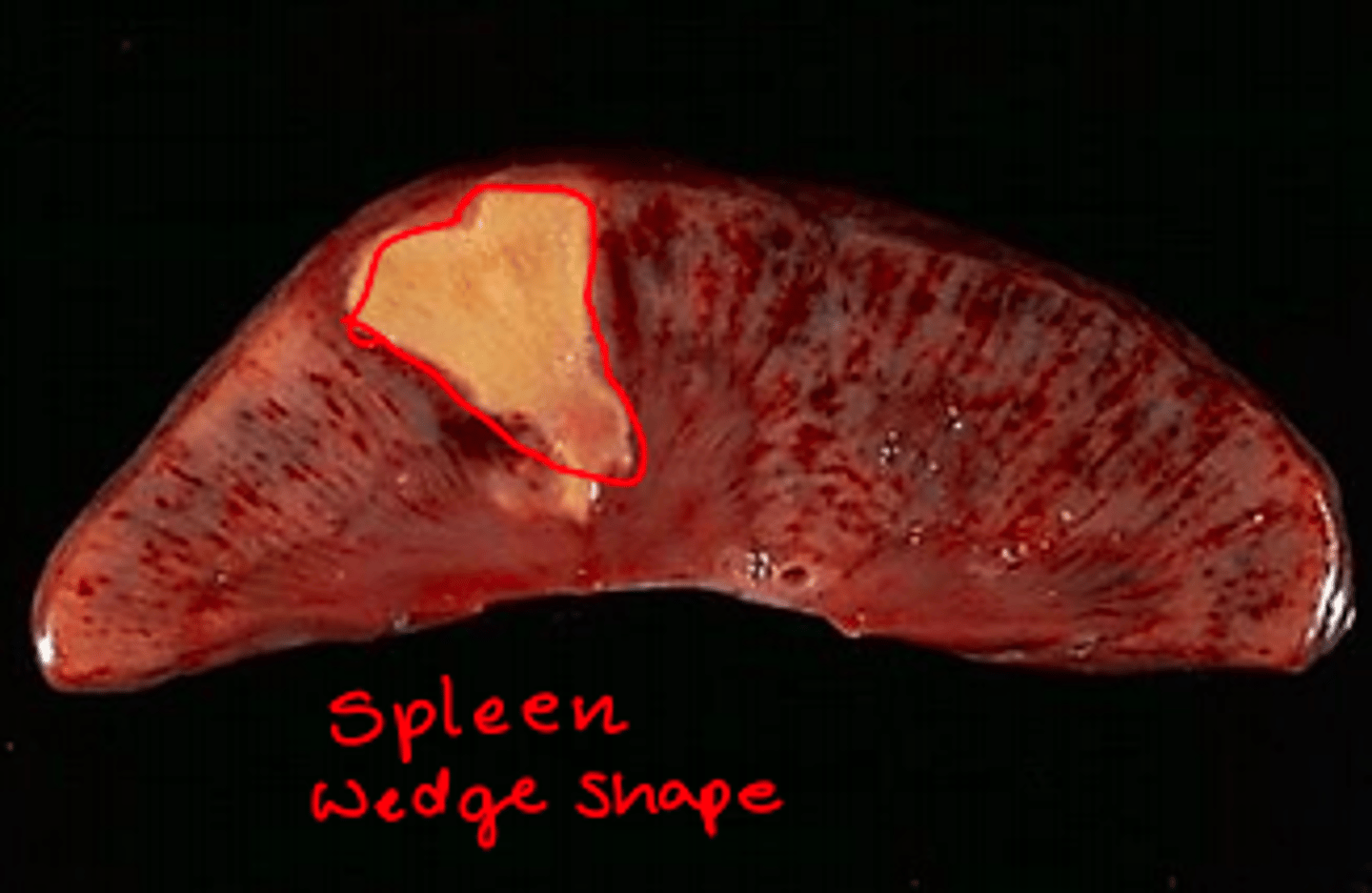 <p>- Occurs in tissue with a single blood supply</p><p>- Pale, little bleeding into organ affected</p><p>- Solid organs like kidney, spleen, heart </p><p>- Leads to arterial occlusion </p>