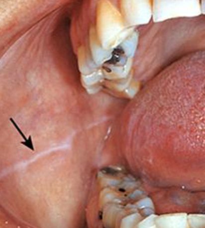 <p>white lane prominent if patients with clenching/bruxing</p>