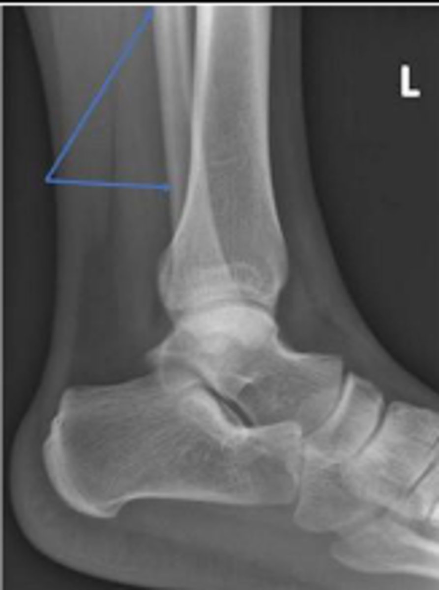 <p>What bone are the arrows pointing t</p>