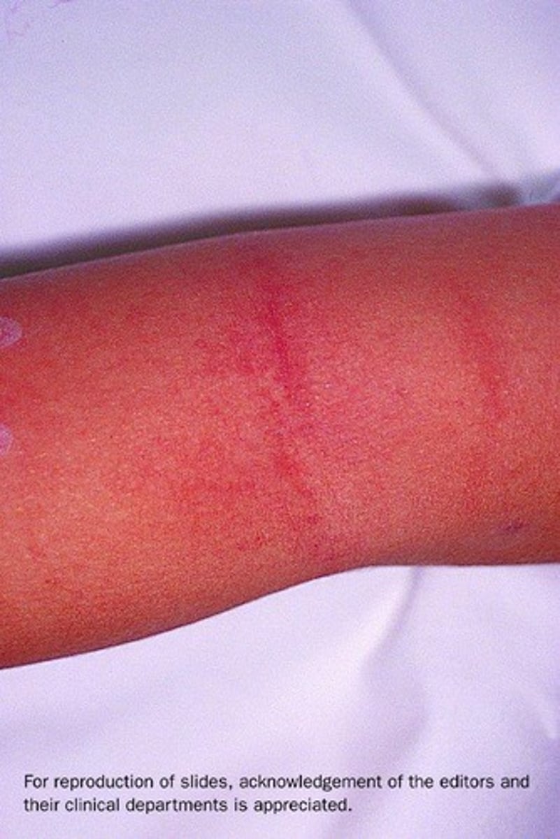 <p>transverse red streaks seen in areas of skin folds</p><p>caused by capillary fragility</p>